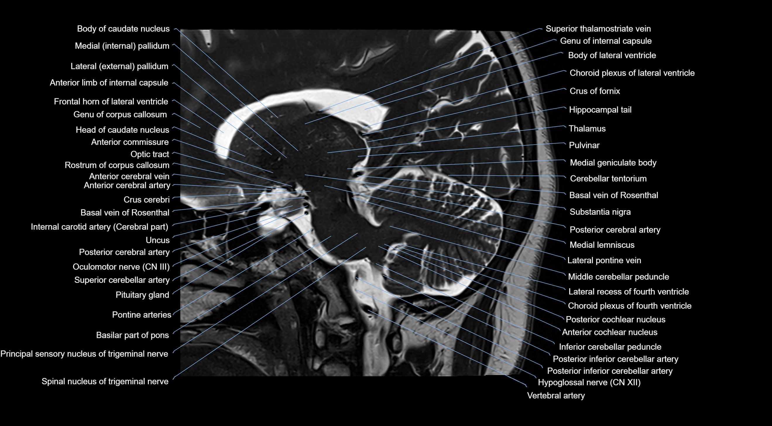 MRI brainstem & basal ganglia anatomy labelled  3T MRI images -img-10001-00019.webp